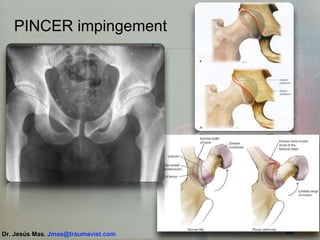 PINCER impingement
Dr. Jesús Mas. Jmas@traumavist.com
 