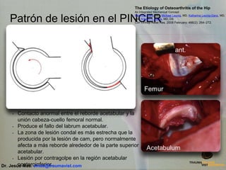 Patrón de lesión en el PINCER
The Etiology of Osteoarthritis of the Hip
An Integrated Mechanical Concept
Reinhold Ganz, MD, Michael Leunig, MD, Katharina Leunig-Ganz, MD,
and William H. Harris, MD, DS
Clin Orthop Relat Res. 2008 February; 466(2): 264–272.
- Contacto anormal entre el reborde acetabular y la
unión cabeza-cuello femoral normal.
- Produce el fallo del labrum acetabular.
- La zona de lesión condal es más estrecha que la
producida por la lesión de cam, pero normalmente
afecta a más reborde alrededor de la parte superior
acetabular.
- Lesión por contragolpe en la región acetabular
posteroinferior.Dr. Jesús Mas. Jmas@traumavist.com
 