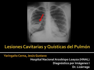 Yaringaño Cerna, Jesús Gustavo
Hospital Nacional Arzobispo Loayza (HNAL)
Diagnóstico por Imágenes I
Dr. Lizárraga
 
