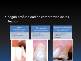 • Según profundidad de compromiso de los
tejidos
Leve
(se observan zonas de
descalcificación)
• No invasivo
• Cirugía periodontal
Moderado
(compromiso de dentina)
• Restauración
• Cirugía periodontal
Severo (pérdida de esmalte y
dentina y compromiso de
dimensión vertical)
• Cirugía periodontal
• Endodoncia
• Exodoncia
 