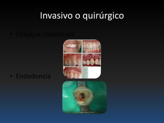 Invasivo o quirúrgico
• Colgajos conectivos
• Endodoncia
 