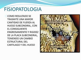 FISIOPATOLOGIA 
COMO RESULTADO SE 
TRASMITE UNA MAYOR 
CANTIDAD DE FUERZA AL 
HUESO SUBCONDRAL, CON 
EL CONSIGUIENTE 
ENGROSAMIENTO Y RIGIDEZ 
DE LA PLACA SUBCONDRAL, 
TENIENDO UN CAMBIO 
ESTRUCTURAL DEL 
CARTILAGO Y DEL HUESO 
 