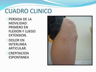 CUADRO CLINICO 
PERDIDA DE LA 
MOVILIDAD: 
PRIMERO EN 
FLEXION Y LUEGO 
EXTENSION. 
DOLOR EN 
INTERLINEA 
ARTICULAR. 
CREPITACION 
ESPONTANEA 
 