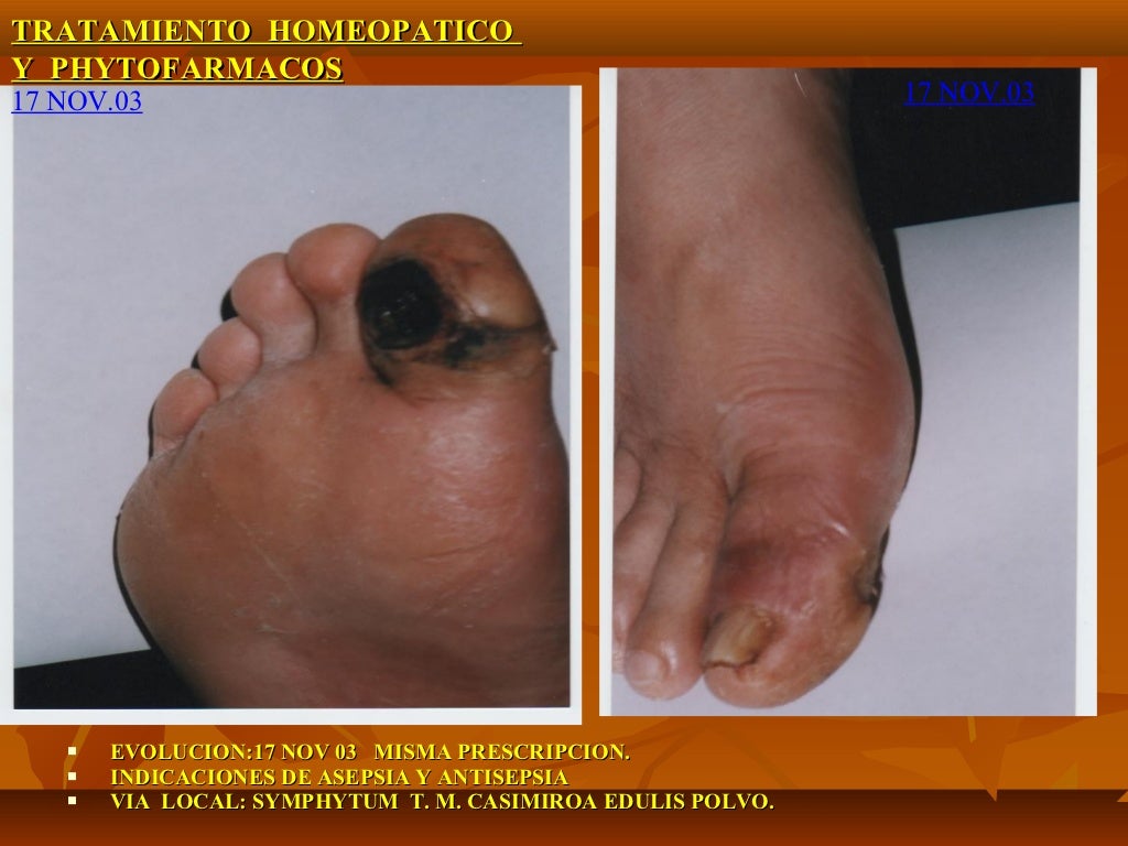 Gangrena seca y lesiones cutaneas