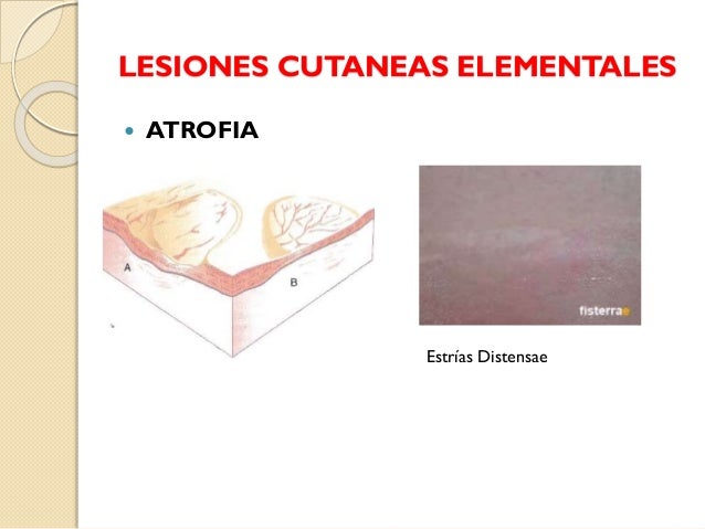 Los novísimos medios de la psoriasis en