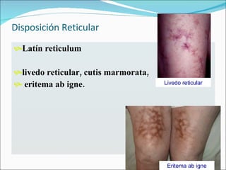 Rebido Reticularis Lesiones Cutaneas Fundamentales Yelementosdiagnosticos | PPT
