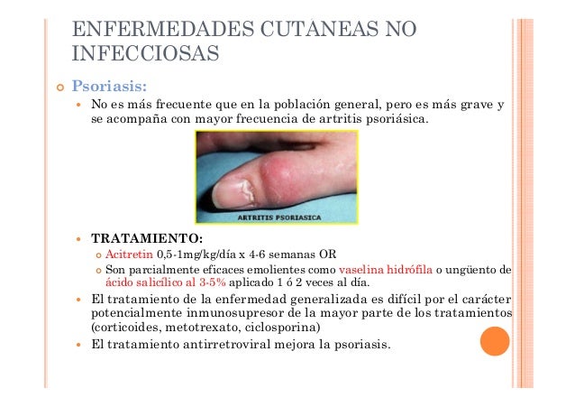 La forma inicial de la psoriasis como curar
