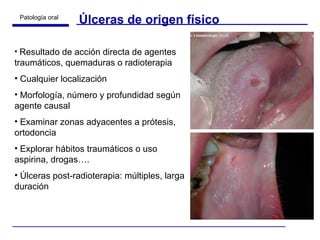 Úlceras de origen físico Resultado de acción directa de agentes traumáticos, quemaduras o radioterapia Cualquier localización Morfología, número y profundidad según agente causal Examinar zonas adyacentes a prótesis, ortodoncia Explorar hábitos traumáticos o uso aspirina, drogas…. Úlceras post-radioterapia: múltiples, larga duración 
