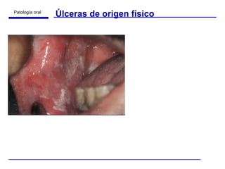Úlceras de origen físico 