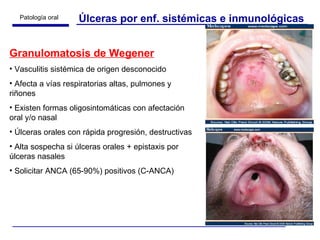Úlceras por enf. sistémicas e inmunológicas Granulomatosis de Wegener Vasculitis sistémica de origen desconocido Afecta a vías respiratorias altas, pulmones y riñones Existen formas oligosintomáticas con afectación oral y/o nasal Úlceras orales con rápida progresión, destructivas Alta sospecha si úlceras orales + epistaxis por úlceras nasales  Solicitar ANCA (65-90%) positivos (C-ANCA) 