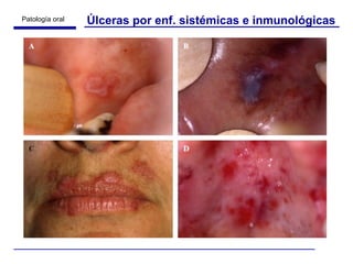 Úlceras por enf. sistémicas e inmunológicas 