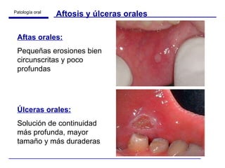 Aftosis y úlceras orales Aftas orales:   Pequeñas erosiones bien circunscritas y poco profundas Úlceras orales:   Solución de continuidad más profunda, mayor tamaño y más duraderas 