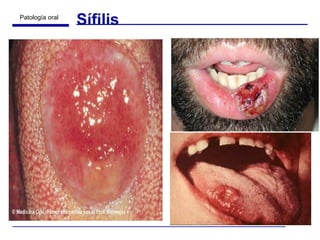 Sífilis 
