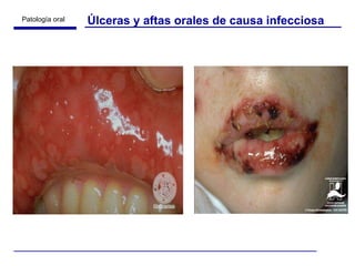 Úlceras y aftas orales de causa infecciosa 
