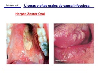 Úlceras y aftas orales de causa infecciosa Herpes Zoster Oral 