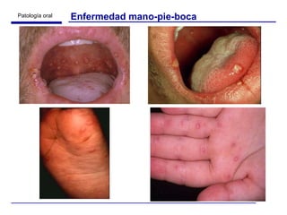 Enfermedad mano-pie-boca 