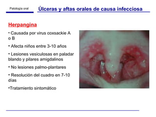 Úlceras y aftas orales de causa infecciosa Herpangina Causada por virus coxsackie A o B Afecta niños entre 3-10 años Lesiones vesiculosas en paladar blando y pilares amigdalinos No lesiones palmo-plantares Resolución del cuadro en 7-10 días Tratamiento sintomático 