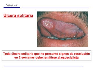 Úlcera solitaria Toda úlcera solitaria que no presente signos de resolución en 2 semanas  debe remitirse al especialista 