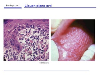 Liquen plano oral 