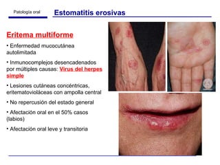 Estomatitis erosivas Eritema multiforme Enfermedad mucocutánea autolimitada Inmunocomplejos desencadenados por múltiples causas:  Virus del herpes simple Lesiones cutáneas concéntricas, eritematovioláceas con ampolla central No repercusión del estado general Afectación oral en el 50% casos (labios) Afectación oral leve y transitoria 