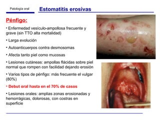 Estomatitis erosivas Pénfigo: Enfermedad vesículo-ampollosa frecuente y grave (sin TTO alta mortalidad) Larga evolución Autoanticuerpos contra desmosomas Afecta tanto piel como mucosas Lesiones cutáneas: ampollas flácidas sobre piel normal que rompen con facilidad dejando erosión Varios tipos de pénfigo: más frecuente el vulgar (80%) Debut oral hasta en el 70% de casos Lesiones orales: amplias zonas erosionadas y hemorrágicas, dolorosas, con costras en superficie 