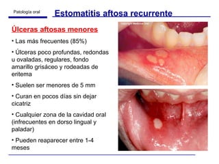 Estomatitis aftosa recurrente Úlceras aftosas menores Las más frecuentes (85%) Úlceras poco profundas, redondas u ovaladas, regulares, fondo amarillo grisáceo y rodeadas de eritema Suelen ser menores de 5 mm Curan en pocos días sin dejar cicatriz Cualquier zona de la cavidad oral (infrecuentes en dorso lingual y paladar) Pueden reaparecer entre 1-4 meses 