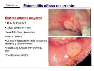 Estomatitis aftosa recurrente Úlceras aftosas mayores 15% de las EAR Mayor tamaño (> 1 cm) Más dolorosas y profundas  Menor número Cualquier localización (más frecuentes en labios y paladar blando) Período de curación mayor (10-30 días) Pueden dejar cicatriz 