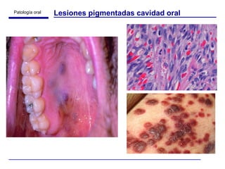 Lesiones pigmentadas cavidad oral 