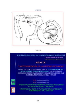 14
FOTO Nº IX
FOTO Nº X
SOCIEDAD PANAMERICANA DE TRAUMA
http//www.panamtrauma.org/lectures/trauma
HISTORIA DEL MANEJO DE LAS LESIONES COLONICAS TRAUMATICAS
AÑOS ‘70
“LA EXTERIORIZACION DE LAS LESIONES SUTURADAS”
APARECE EL CONCEPTO Y LA PRACTICA DE LA “EXTERIORIZACION”
DE LAS LESIONES COLONICAS REPARADAS. LOS RESULTADOS
OBTENIDOS FUERON PRACTICAMENTE DESASTROSOS, POR LO CUAL
FUE TOTALMENTE DESACONSEJADO SU USO.
1975: KIRKPATRICK Y RAIPAL
1977: MATOLOG Y WOLFMAN
MATOLOG NM, WOLFMAN EF. “PRIMARY REPAIR OF COLONIC INJURIES:
A CLINICAL EVALUATION” J.TRAUMA 1977.
KIRKPATRICK J, & RAJPAL S. “THE INJURED COLON: THERAPEUTIC
CONSIDERATIONS”. AM. J. SURG. 1975
 