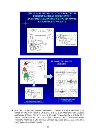 68
QUE EN LAS LESIONES DEL COLON DERECHO SE
PUEDEN PRACTICAR RESECCIONES Y
ANASTOMOSIS EN UN SOLO TIEMPO SIN MAYOR
RIESGO PARA EL PACIENTE
ILEOTRASVERSOSTOMIAT-T
ILEOTRANSVERSOSTOMIA
LATEROLATERAL
LESIONES DEL COLON
DERECHO
QUE LAS LESIONES DEL COLON TRANSVERSO, CUANDO SON MUY EXTENSAS (C.I.S.
GRADO O TIPO III DE FLINT O UN C.O.I.S. 4 O 5), O EN PACIENTES CON LESIONES
ASOCIADAS SEVERAS, CON A.T.I. > o = A 25, UNA TÉCNICA RÁPIDA Y SEGURA ES EL
SIMPLE DIVORCIAMIENTO DE LOS CABOS, DEJANDO UNA COLOSTOMIA PLANA
TERMINAL PROXIMAL Y UNA FISTULA MUCOSA DEL CABO DISTAL. MAS AUN, SI SE
PRACTICARA UNA LAPAROSTOMÍA.
 