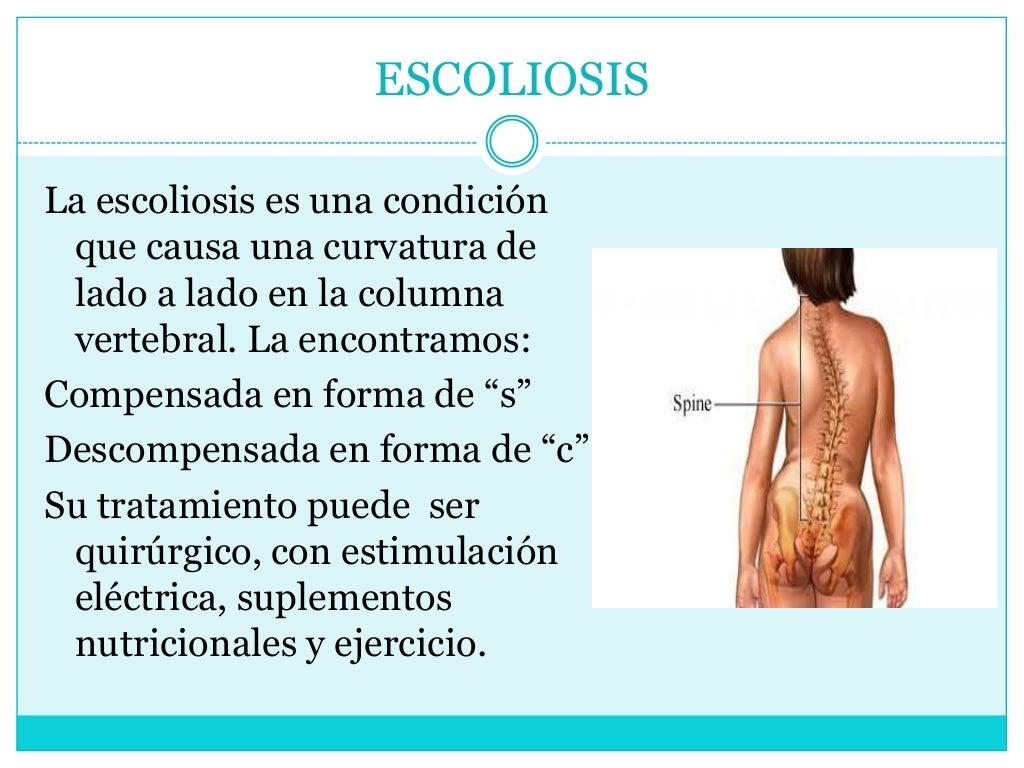 ESCOLIOSIS
La escoliosis es una condición
que causa una curvatura de
lado a lado en la columna
vertebral. La encontramos:
...