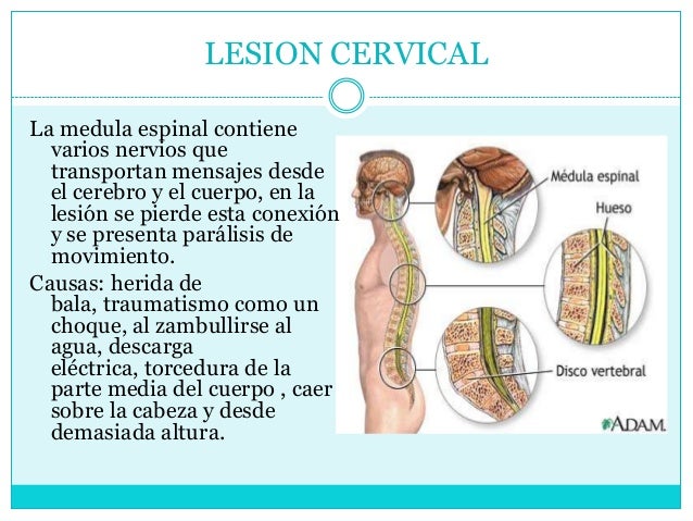 La osteocondrosis sheynogo del departamento de la columna vertebral 2 3 st