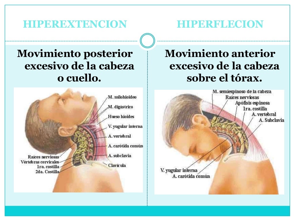 HIPEREXTENCION

HIPERFLECION

Movimiento posterior
excesivo de la cabeza
o cuello.

Movimiento anterior
excesivo de la cab...