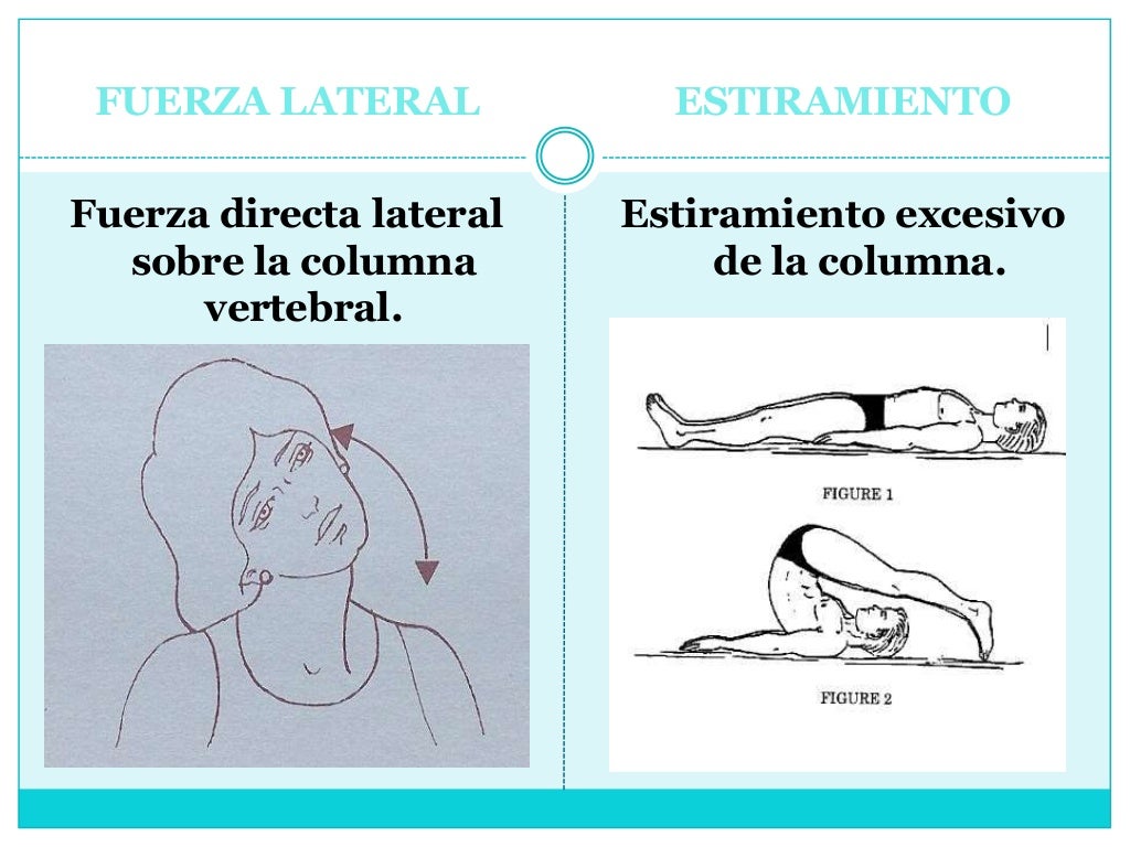 FUERZA LATERAL

ESTIRAMIENTO

Fuerza directa lateral
sobre la columna
vertebral.

Estiramiento excesivo
de la columna.

 
