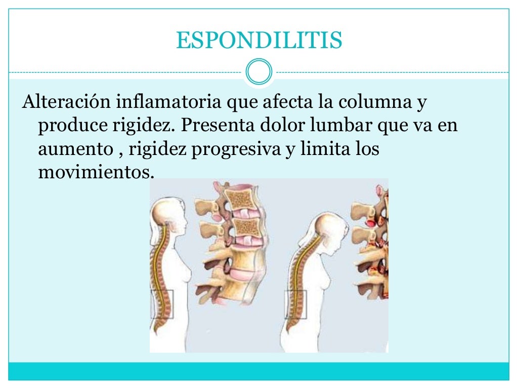 ESPONDILITIS
Alteración inflamatoria que afecta la columna y
produce rigidez. Presenta dolor lumbar que va en
aumento , ri...