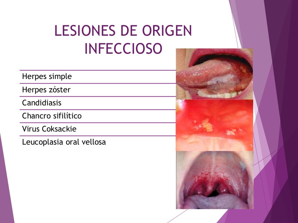 Lesiones de la mucosa oral