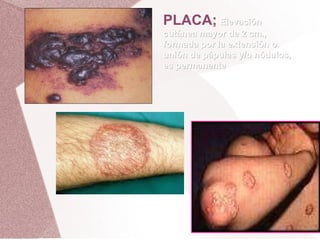 PLACA;   Elevación cutánea mayor de 2 cm., formada por la extensión o unión de pápulas y/o nódulos, es permanente 