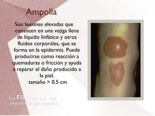 Ampolla Son lesiones elevadas que consisten en una vejiga llena de líquido linfático y otros fluidos corporales, que se forma en la epidermis. Puede producirse como reacción a quemaduras o fricción y ayuda a reparar el daño producido a la piel.  tamaño > 0.5 cm Las  Flictenas  son ampollas de gran tamaño. 