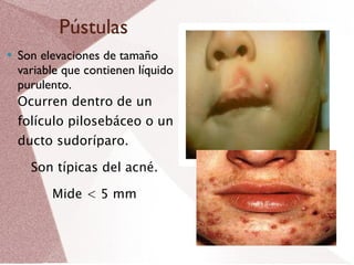 Pústulas Son elevaciones de tamaño variable que contienen líquido purulento. Ocurren dentro de un folículo pilosebáceo o un ducto sudoríparo. Son típicas del acné. Mide < 5 mm 