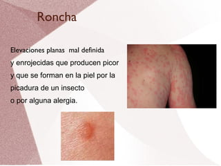 Roncha Elevaciones planas  mal definida  y enrojecidas que producen picor  y que se forman en la piel por la  picadura de un insecto  o por alguna alergia. 