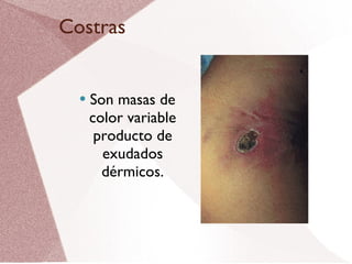 Costras Son masas de color variable producto de exudados dérmicos. 