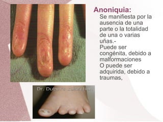 Anoniquia: Se manifiesta por la ausencia de una parte o la totalidad de una o varias uñas.- Puede ser congénita, debido a malformaciones O puede ser adquirida, debido a traumas,  