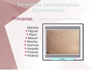 Primarias: Mancha Pápula Placa Nódulo Roncha  Vesícula Ampolla Pústula Flictena aparecen  sobre una piel sana 