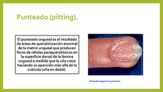 Punteado (pitting).
El punteado ungueal es el resultado
de áreas de queratinización anormal
de la matriz ungueal que producen
focos de células paraqueratósicas en
la superficie dorsal de la lámina
ungueal a medida que la uña crece
haciendo su aparición más allá de la
cutícula (uña en dedal)
Punteado ungueal en psoriasis.
 
