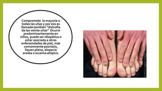Compromete la mayoría o
todas las uñas y por eso es
llamada también “distrofia
de las veinte uñas” Ocurre
predominantemente en
niños, puede ser idiopática o
estar asociada a otras
enferemdades de piel, más
comúnmente psoriasis,
liquen plano, alopecia
areata o eccema atópico.
 