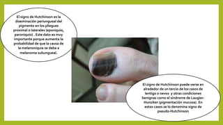 El signo de Hutchinson es la
diseminación periungueal del
pigmento en los pliegues
proximal o laterales (eponiquio,
paroniquio) . Este dato es muy
importante porque aumenta la
probabilidad de que la causa de
la melanoniquia se deba a
melanoma subungueal.
El signo de Hutchinson puede verse en
alrededor de un tercio de los casos de
lentigo o nevos y otras condiciones
benignas como el síndrome de Laugier-
Hunziker (pigmentación mucosa). En
estos casos se lo denomina signo de
pseudo-Hutchinson
 