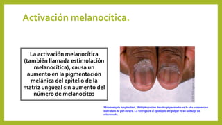 Activación melanocítica.
La activación melanocítica
(también llamada estimulación
melanocítica), causa un
aumento en la pigmentación
melánica del epitelio de la
matriz ungueal sin aumento del
número de melanocitos
Melanoniquia longitudinal. Múltiples estrías lineales pigmentadas en la uña, comunes en
individuos de piel oscura. La verruga en el eponiquio del pulgar es un hallazgo no
relacionado.
 