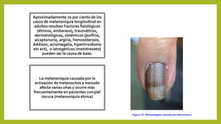 Aproximadamente 70 por ciento de los
casos de melanoniquia longitudinal en
adultos resultan Factores fisiológicos
(étnicos, embarazo), traumáticos,
dermatológicos, sistémicos (porfiria,
alcaptonuria, argiria, hemosiderosis,
Addison, acromegalia, hipertiroidismo
etc ect), o iatrogénicos (metotrexato)
pueden ser la causa de base.
La melanoniquia causada por la
activación de melanocitos a menudo
afecta varias uñas y ocurre más
frecuentemente en pacientes con piel
oscura (melanoniquia étnica)
Figura 25. Melanoniquia causada por hidroxiurea.
 