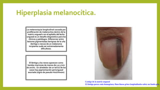 Hiperplasia melanocítica.
La melanoniquia longitudinal causada por
proliferación de melanocitos dentro de la
matriz ungueal o en el epitelio del lecho
ungueal es un desafío diagnóstico para los
clínicos y patólogos. Diferenciar entre
lesiones pigmentadas benignas de la uña
(lentigo o nevus) de un melanoma
incipiente suele ser extremadamente
dificultoso.
El léntigo y los nevos aparecen como
bandas marrones de menos de 3 a 5 mm
de ancho . En alrededor de un tercio de los
casos hay pigmentación periungueal
asociada (signo de pseudo-Hutchinson)
Lentigo de la matriz ungueal
El léntigo parece más homogéneo, finas líneas grises longitudinales sobre un fondo gris.
 