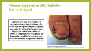 Hemorragias en astilla (Splinter
hemorrhages)
Las hemorragias en astillas son
pequeñas líneas longitudinales de
color rojo a negro debajo de la placa
ungueal. En general se localizan en
la porción más distal del lecho
ungueal y representan la ruptura de
los capilares del lecho ungueal que
están orientados longitudinalmente
Hemorragia en astilla del dedo gordo.
Hemorragia en astilla traumática, ubicada distalmente en el lecho ungueal.
 